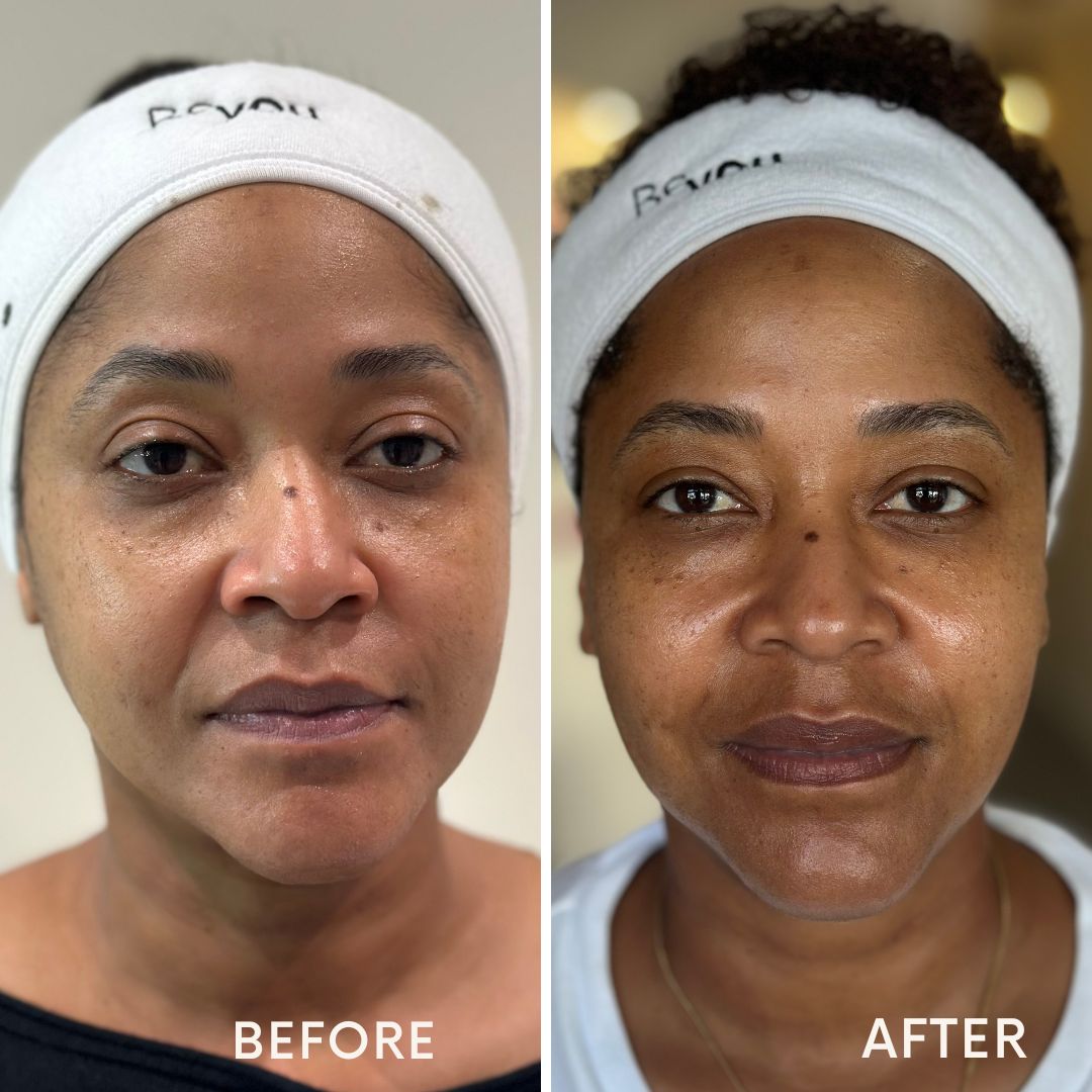 Antes e depois HIFU facial — cliente real Be You Concept Beauty, Alcabideche