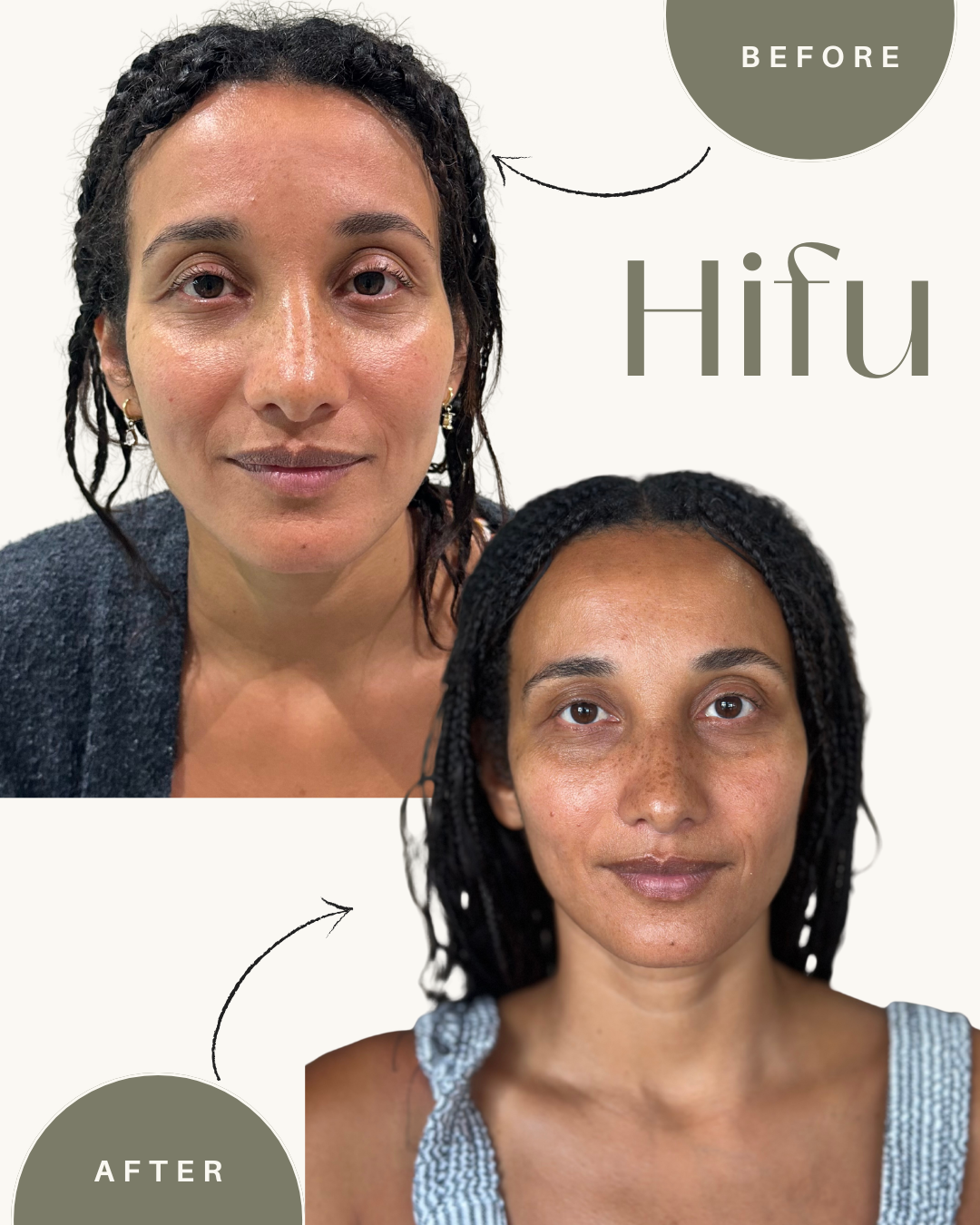 Antes e depois HIFU — resultado real de lifting facial sem cirurgia, Be You Concept Beauty