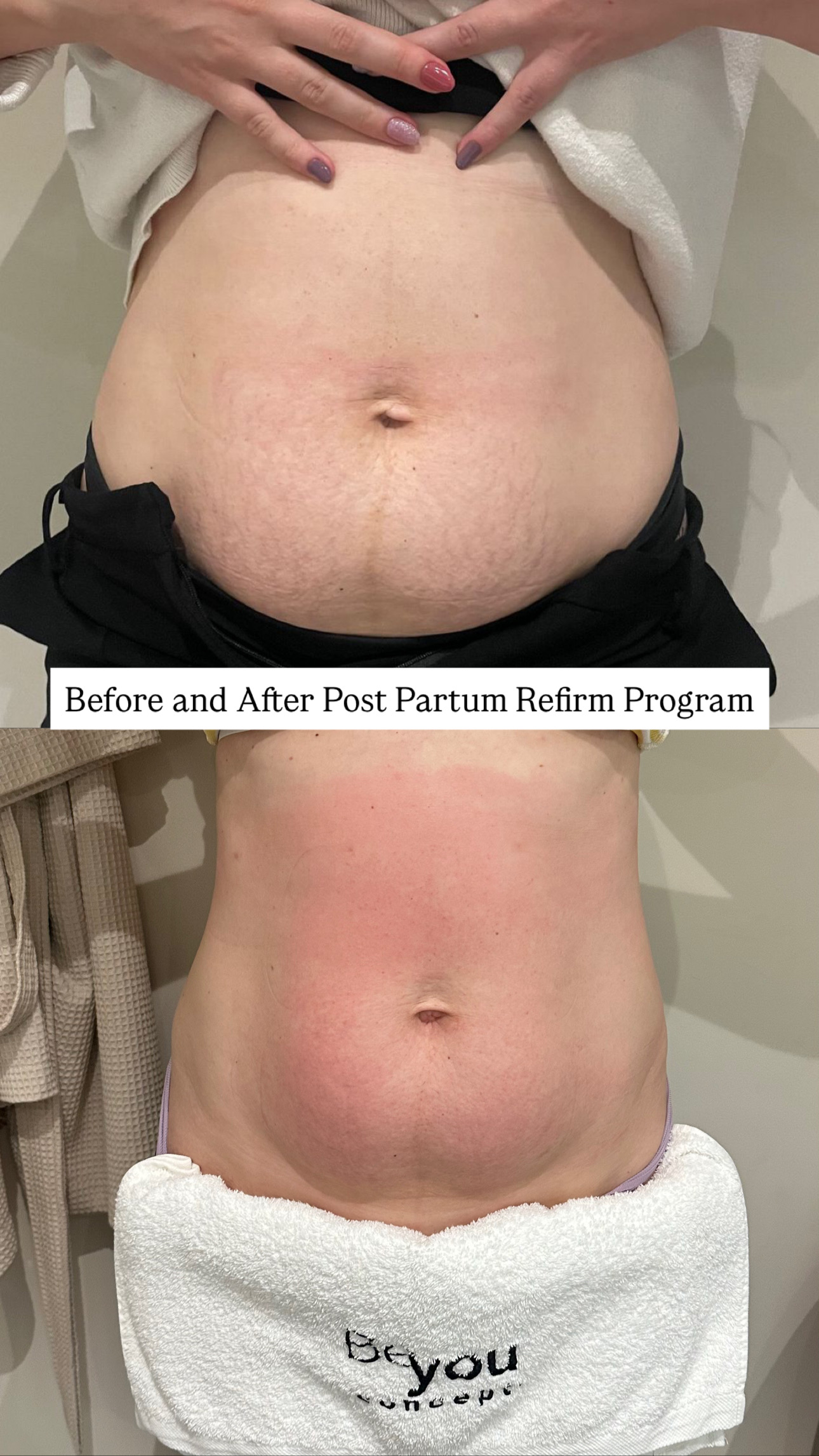 Resultado real de HIFU corporal — antes e depois do abdómen, programa pós-parto Be You Concept Beauty