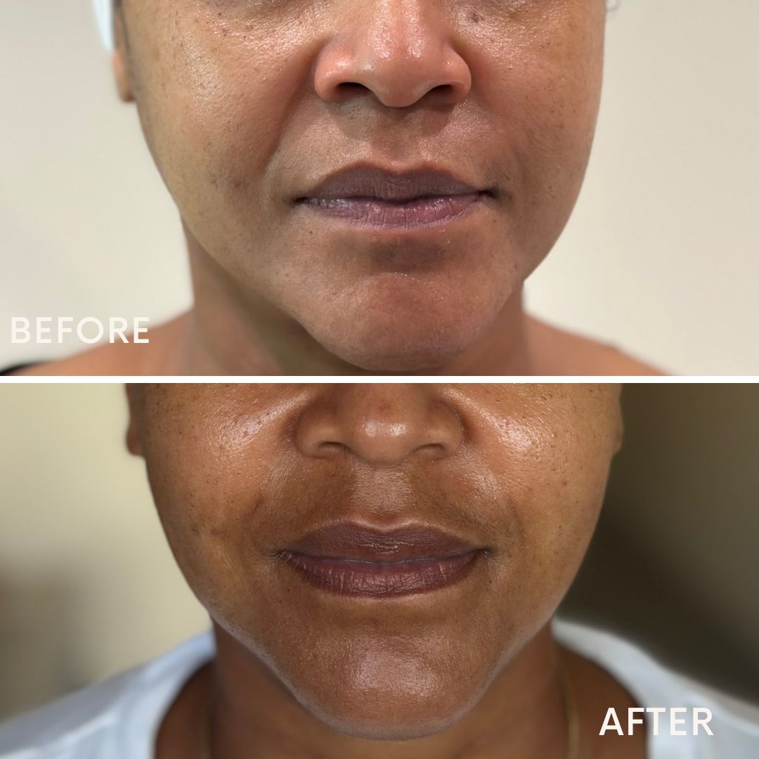 Resultado real de HIFU facial — antes e depois no queixo e contorno labial, Be You Concept Beauty