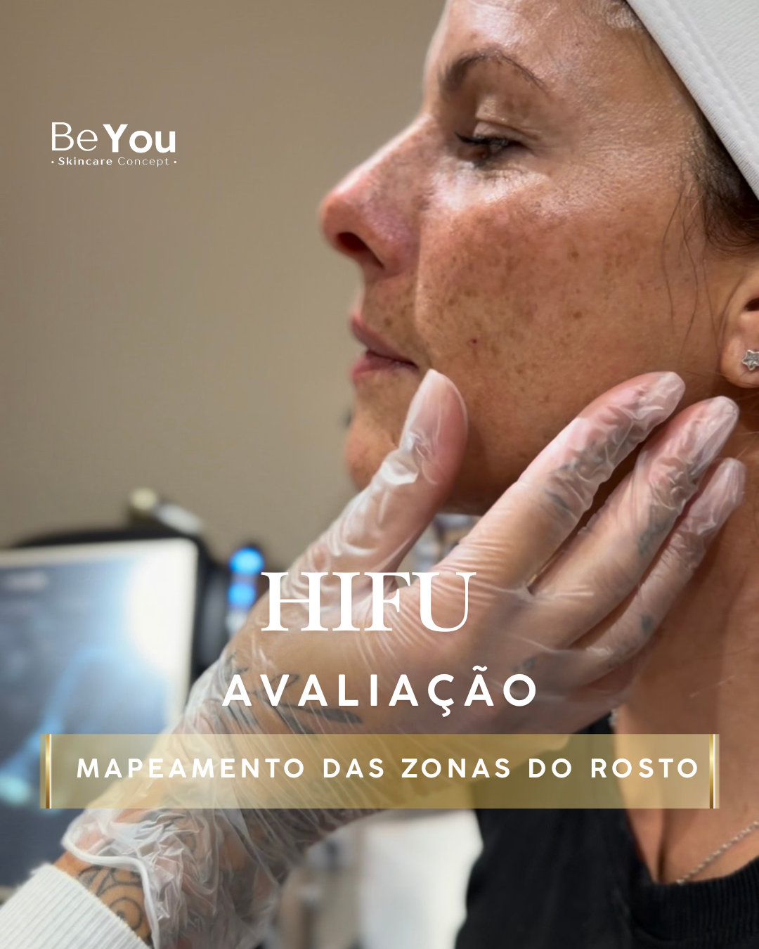 Avaliação técnica HIFU na Be You Concept Beauty — mapeamento das zonas do rosto antes do tratamento